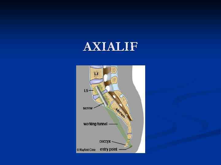 AXIALIF 