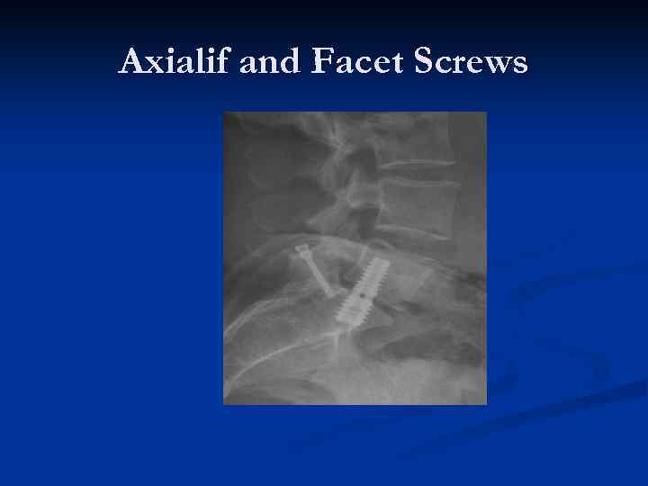 Axialif and Facet Screws 