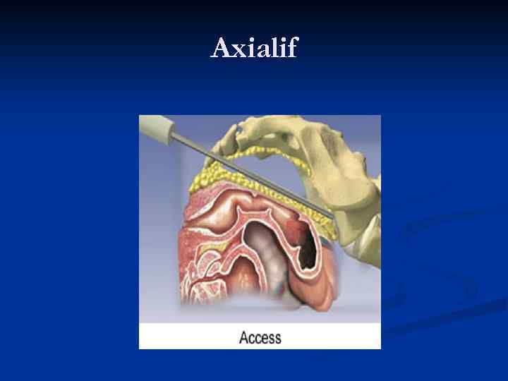 Axialif 