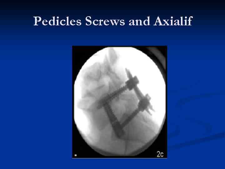 Pedicles Screws and Axialif 