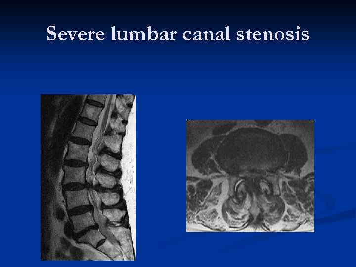 Severe lumbar canal stenosis 