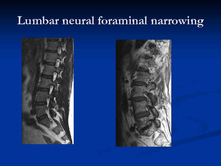 Lumbar neural foraminal narrowing 