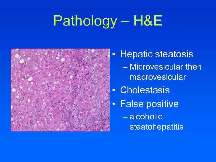 Pathology – H&E • Hepatic steatosis – Microvesicular then macrovesicular • Cholestasis • False