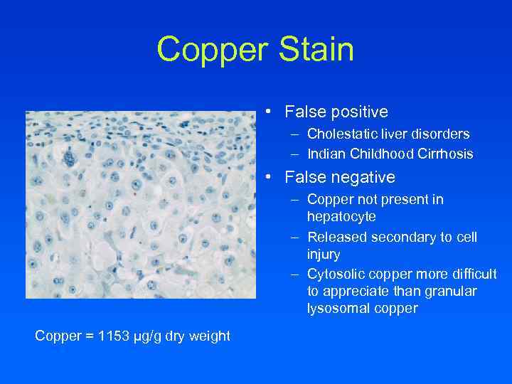 Copper Stain • False positive – Cholestatic liver disorders – Indian Childhood Cirrhosis •