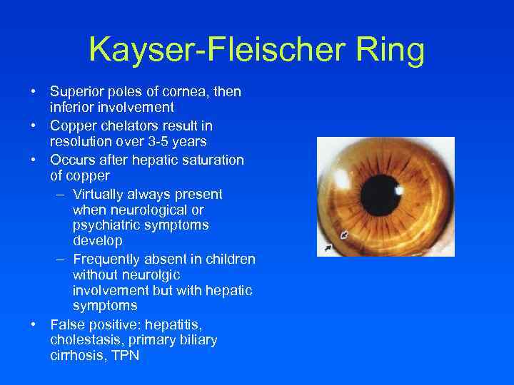 Kayser-Fleischer Ring • Superior poles of cornea, then inferior involvement • Copper chelators result