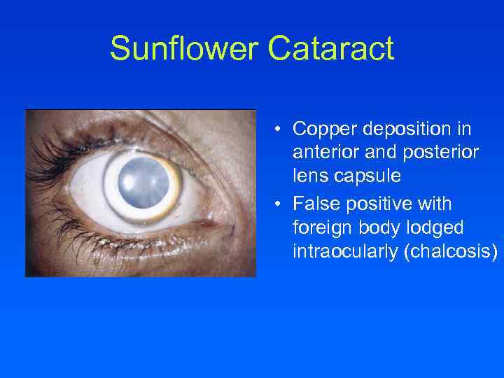 Sunflower Cataract • Copper deposition in anterior and posterior lens capsule • False positive