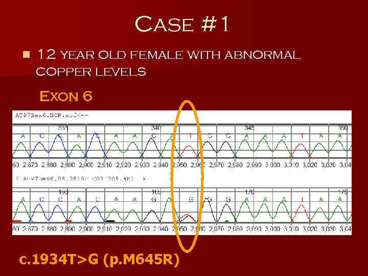 Case #1 n 12 year old female with abnormal copper levels Exon 6 c.