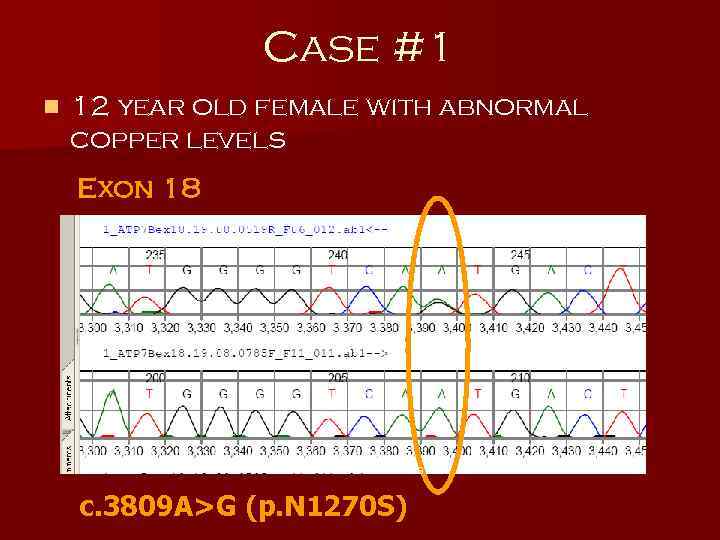 Case #1 n 12 year old female with abnormal copper levels Exon 18 c.