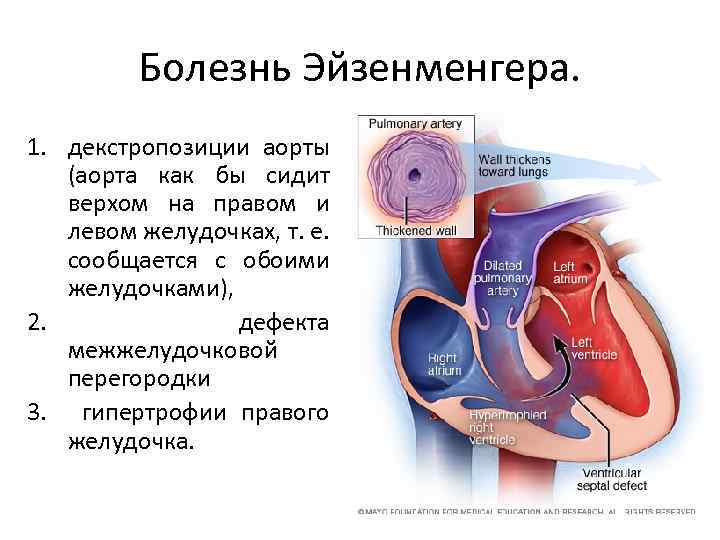 Синдром эйзенменгера презентация