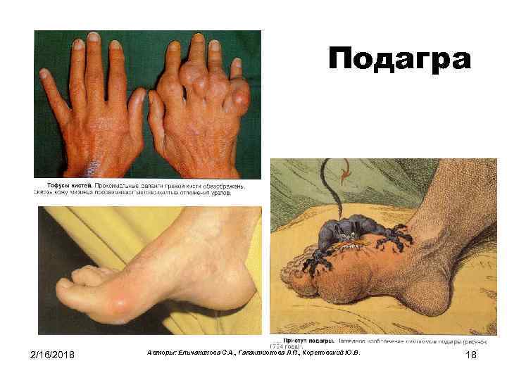 Подагра 2/16/2018 Авторы: Ельчанинова С. А. , Галактионова Л. П. , Кореновский Ю. В.