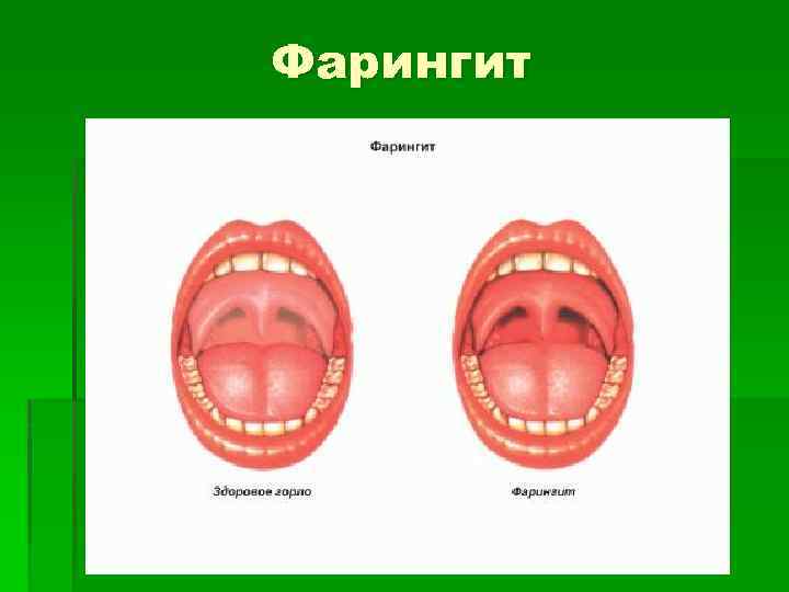 Фарингит 