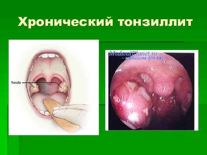 Хронический тонзиллит 