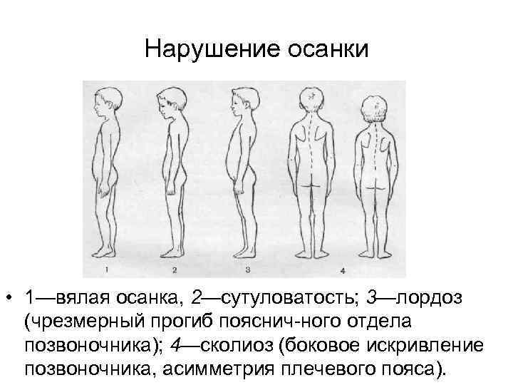 Нарушение осанки • 1—вялая осанка, 2—сутуловатость; 3—лордоз (чрезмерный прогиб пояснич ного отдела позвоночника); 4—сколиоз