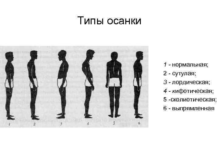 Типы осанки 1 - нормальная; 2 сутулая; 3 - лордическая; 4 - кифотическая; 5