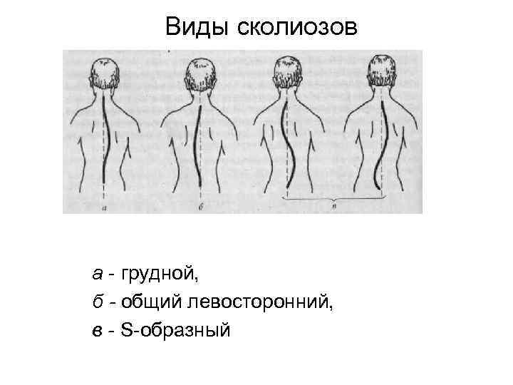 Виды сколиозов а грудной, б - общий левосторонний, в - S образный 