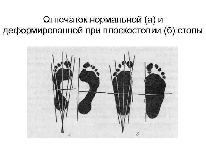 Отпечаток нормальной (а) и деформированной при плоскостопии (б) стопы 
