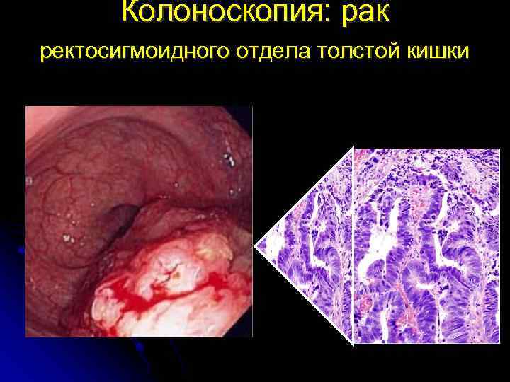 Колоноскопия: рак ректосигмоидного отдела толстой кишки 