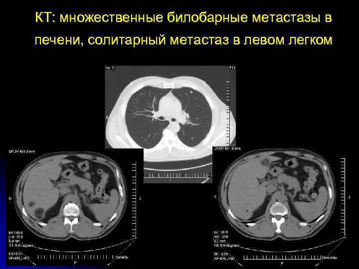 КТ: множественные билобарные метастазы в печени, солитарный метастаз в левом легком 