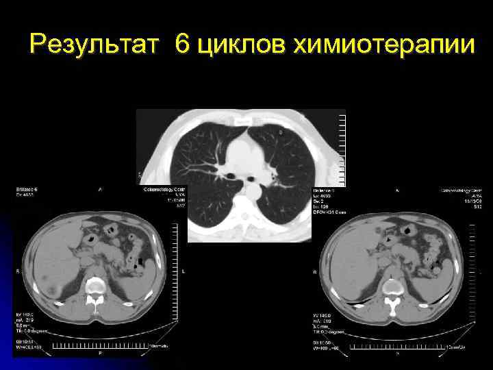 Результат 6 циклов химиотерапии 