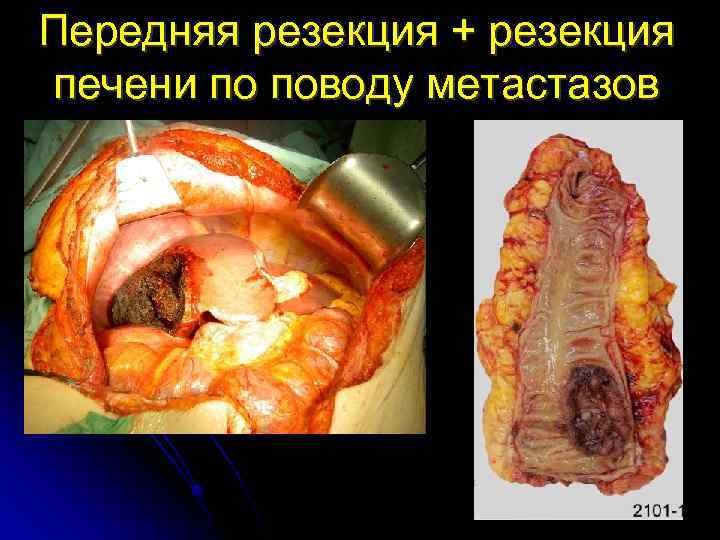 Передняя резекция + резекция печени по поводу метастазов 