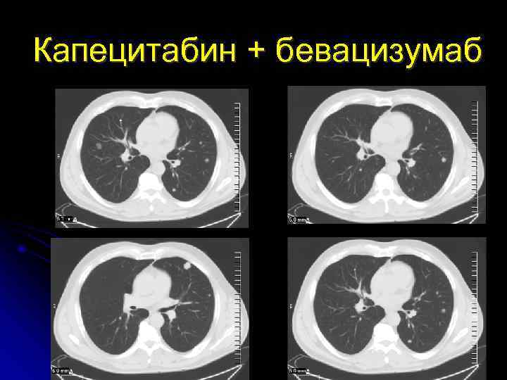 Капецитабин + бевацизумаб 