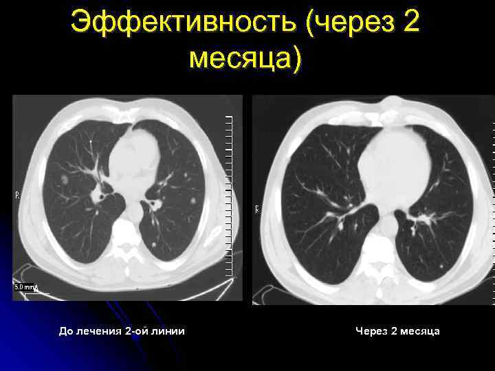 Эффективность (через 2 месяца) До лечения 2 -ой линии Через 2 месяца 