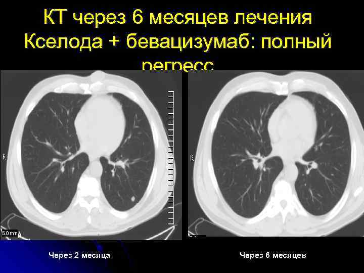 КТ через 6 месяцев лечения Кселода + бевацизумаб: полный регресс Через 2 месяца Через