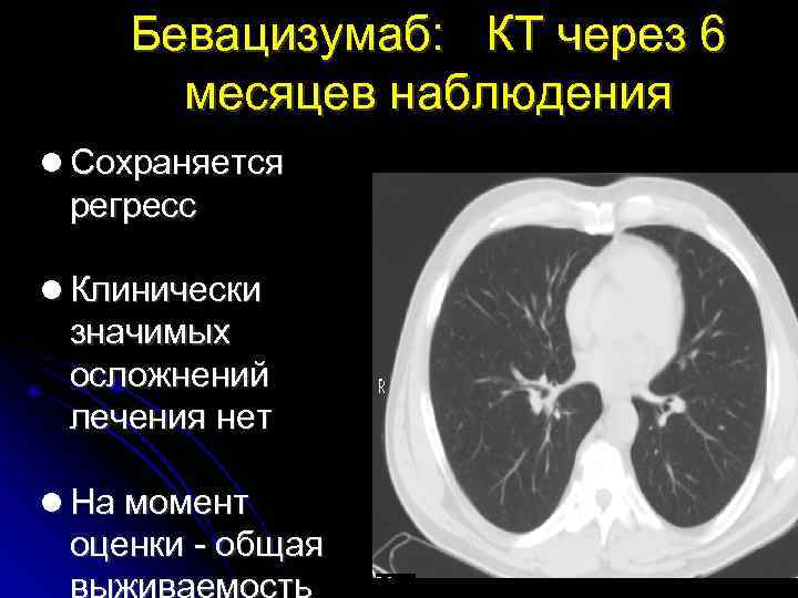 Бевацизумаб: КТ через 6 месяцев наблюдения Сохраняется регресс Клинически значимых осложнений лечения нет На