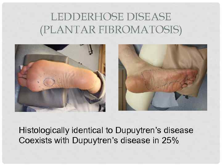 LEDDERHOSE DISEASE (PLANTAR FIBROMATOSIS) Histologically identical to Dupuytren’s disease Coexists with Dupuytren’s disease in