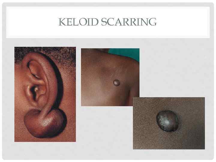 KELOID SCARRING 