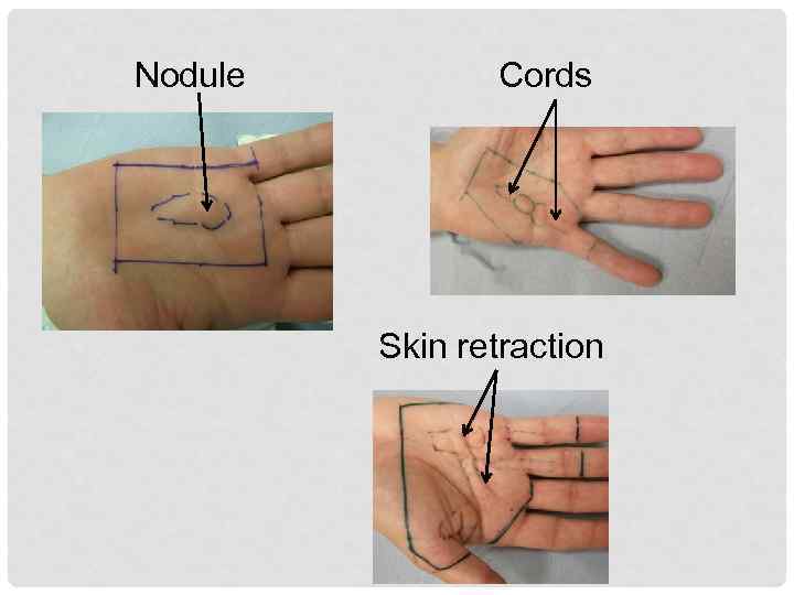 Nodule Cords Skin retraction 