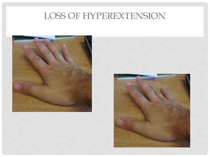 LOSS OF HYPEREXTENSION 