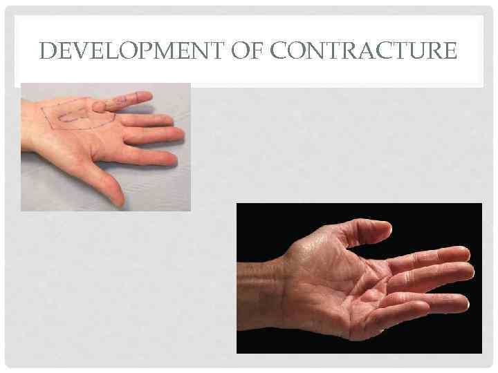 DEVELOPMENT OF CONTRACTURE 