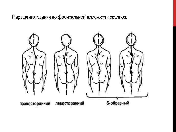 Рассмотрите рисунки 1 4 с изображением типов осанок человека как называют нарушение осанки