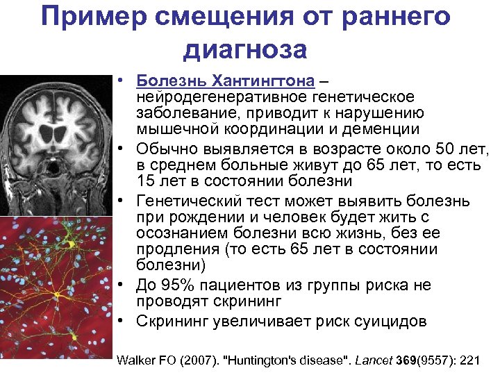 Пример смещения от раннего диагноза • Болезнь Хантингтона – нейродегенеративное генетическое заболевание, приводит к