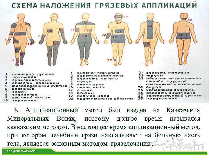 Методики грязелечения. Схема наложения грязевых аппликаций. Аппликации грязевые схемы. Схема наложения озокерита.