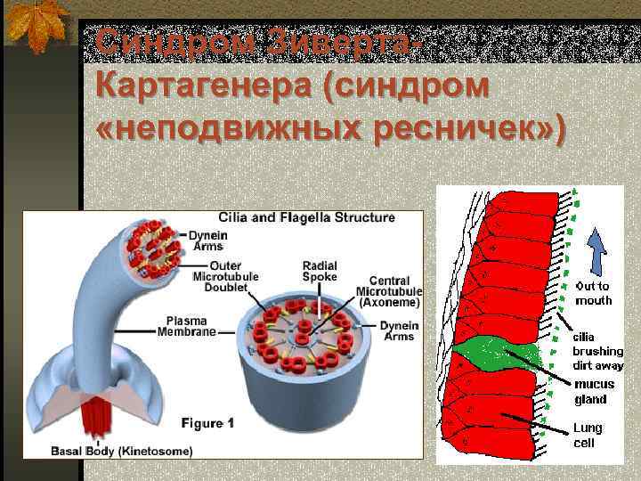 Синдром Зиверта. Картагенера (синдром «неподвижных ресничек» ) 