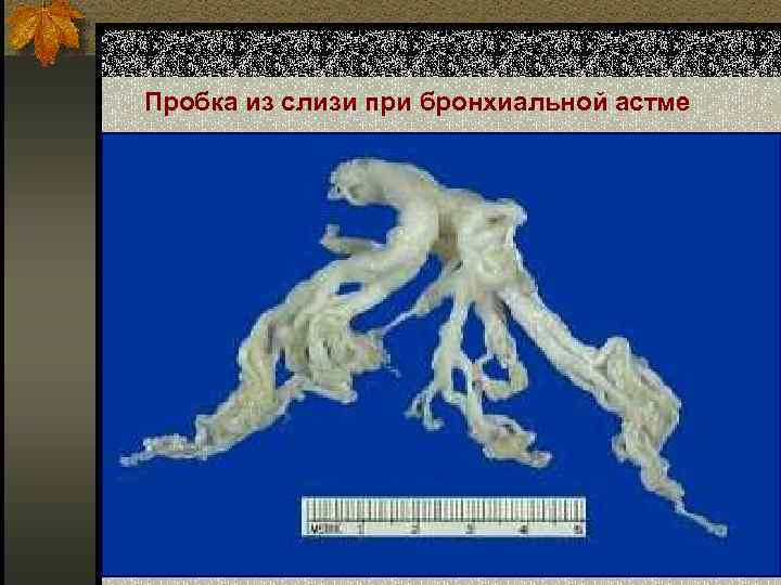 Пробка из слизи при бронхиальной астме 