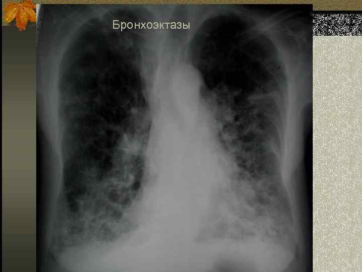 Бронхоэктазы 