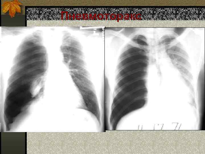 Пневмоторакс 