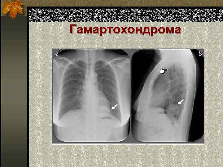 Гамартохондрома 