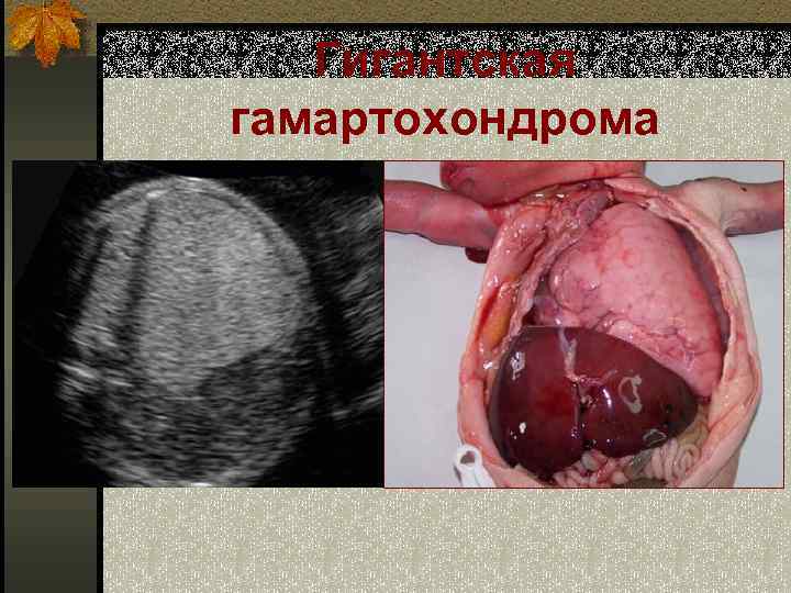 Гигантская гамартохондрома 