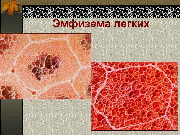 Эмфизема легких 