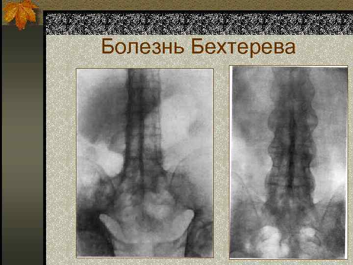 Болезнь Бехтерева 