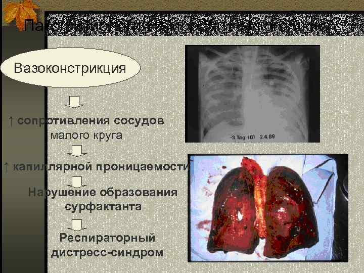 Патофизиология геморрагического шока Вазоконстрикция ↑ сопротивления сосудов малого круга ↑ капиллярной проницаемости Нарушение образования