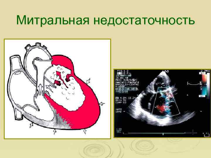 Митральная недостаточность 