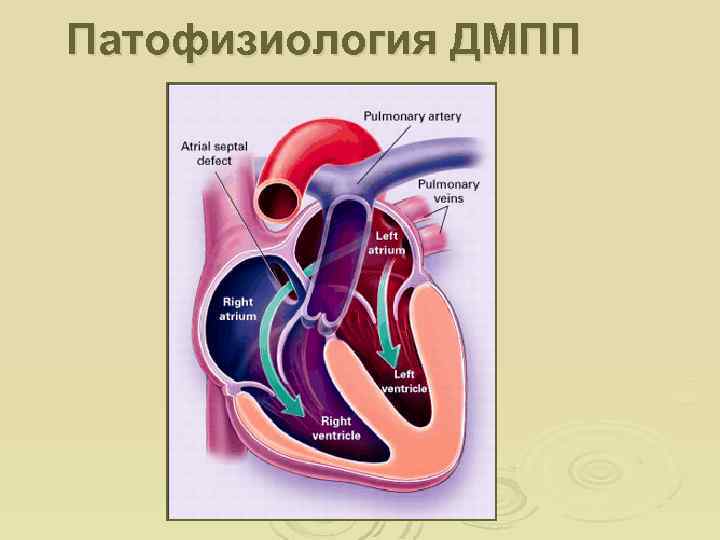 Патофизиология ДМПП 