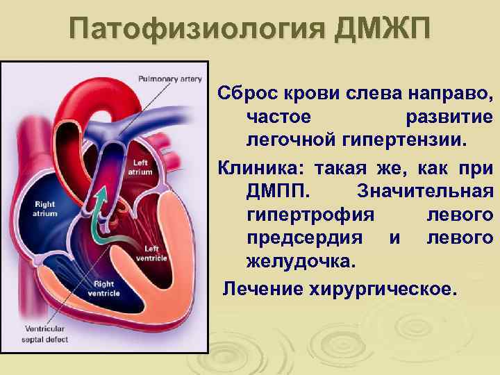 Патофизиология ДМЖП Сброс крови слева направо, частое развитие легочной гипертензии. Клиника: такая же, как