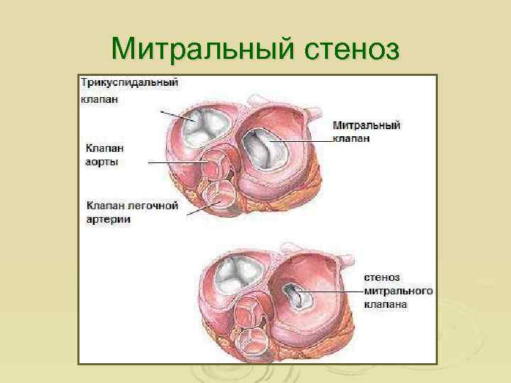 Митральный стеноз 