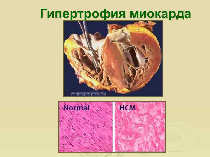 Гипертрофия миокарда 